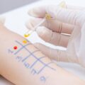 Testy skórne czy z krwi – co wybrać przy diagnozowaniu alergii?
